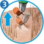 Zecke entfernen: Zeckenschlinge Schritt 3